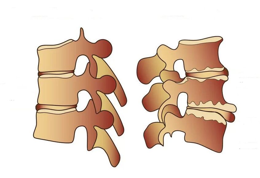 coloana vertebrala sanatoasa si bolnava