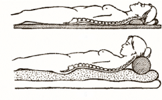 Figura osteochondrozei